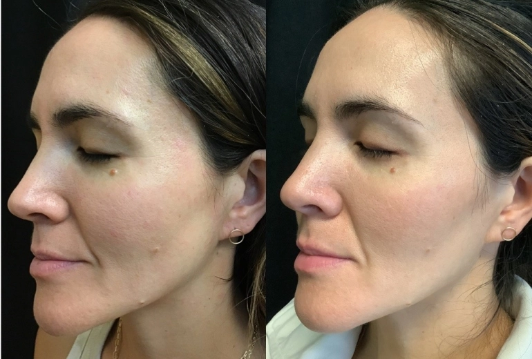 Laser Toning/Pico tại MEDIKA WELLNESS & SPA – Hỗ trợ cải thiện nám, thâm sạm và trẻ hóa da